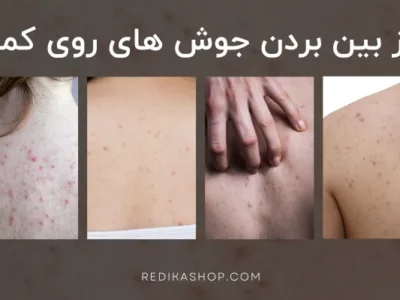 چجوری از آکنه و جوش روی کمر خلاص شیم؟