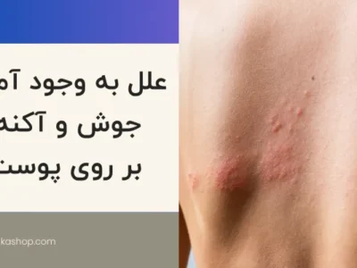 علل به وجودآمدن جوش روی صورت و بدن چیست ؟ معرفی انواع جوش و راه های مقابله با آن ها