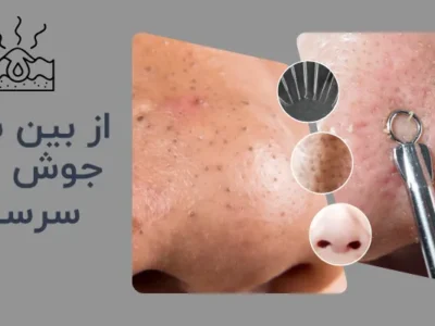 از بین بردن جوش های سر سیاه