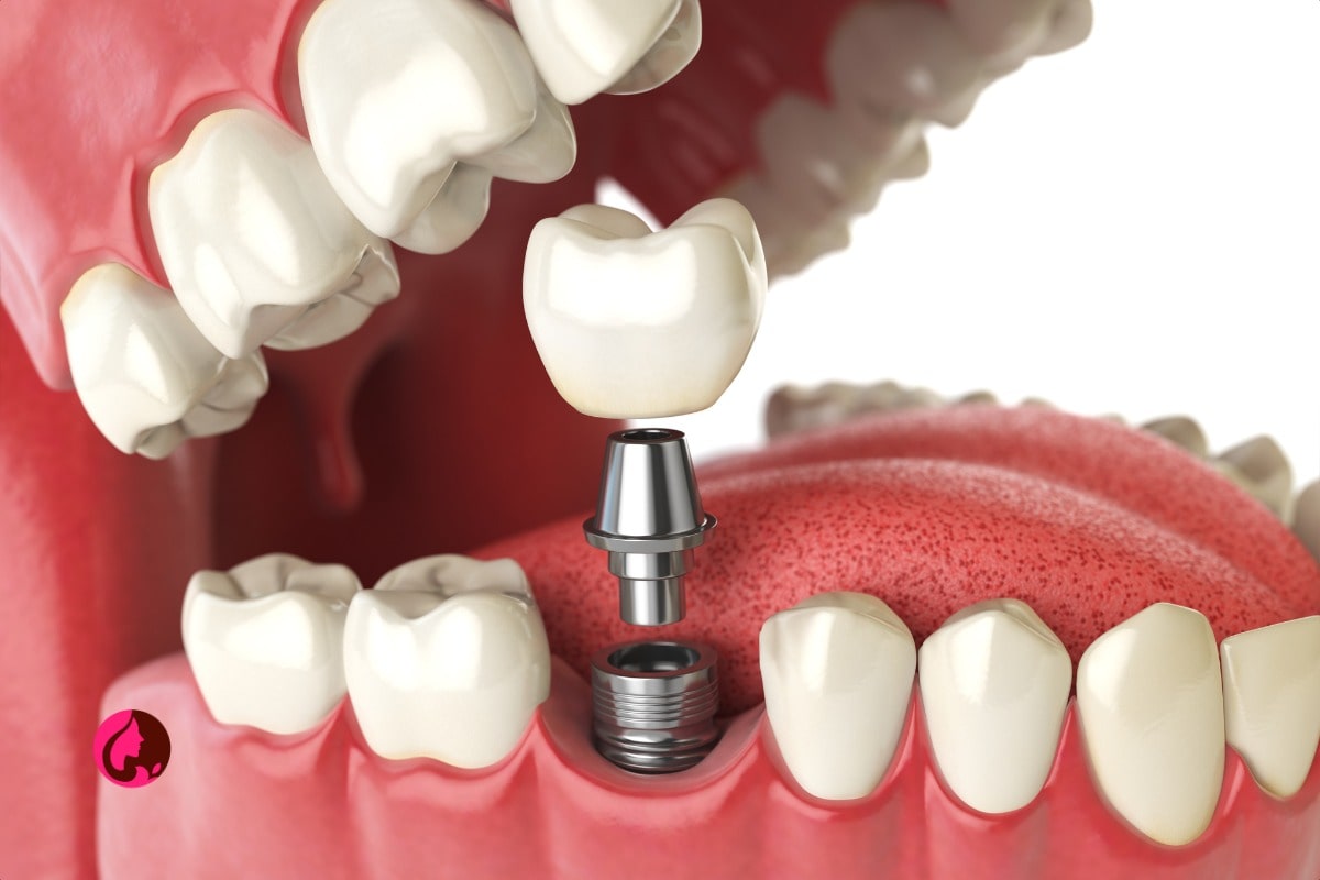 دلایل و روش‌های درآوردن ایمپلنت دندان