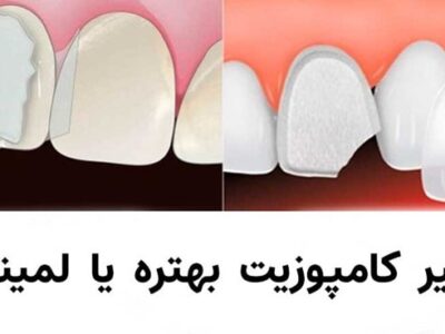 ونیر کامپوزیت بهتره یا لمینت؟