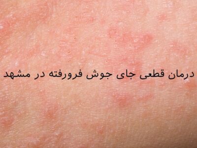 درمان قطعی جای جوش فرورفته در مشهد | سابسیژن + تزریق چربی صورت