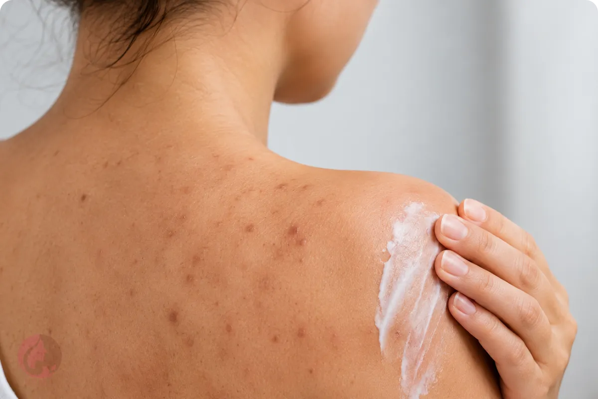 لک جای جوش بدن و تیرگی پس از آکنه روی پشت و شانه