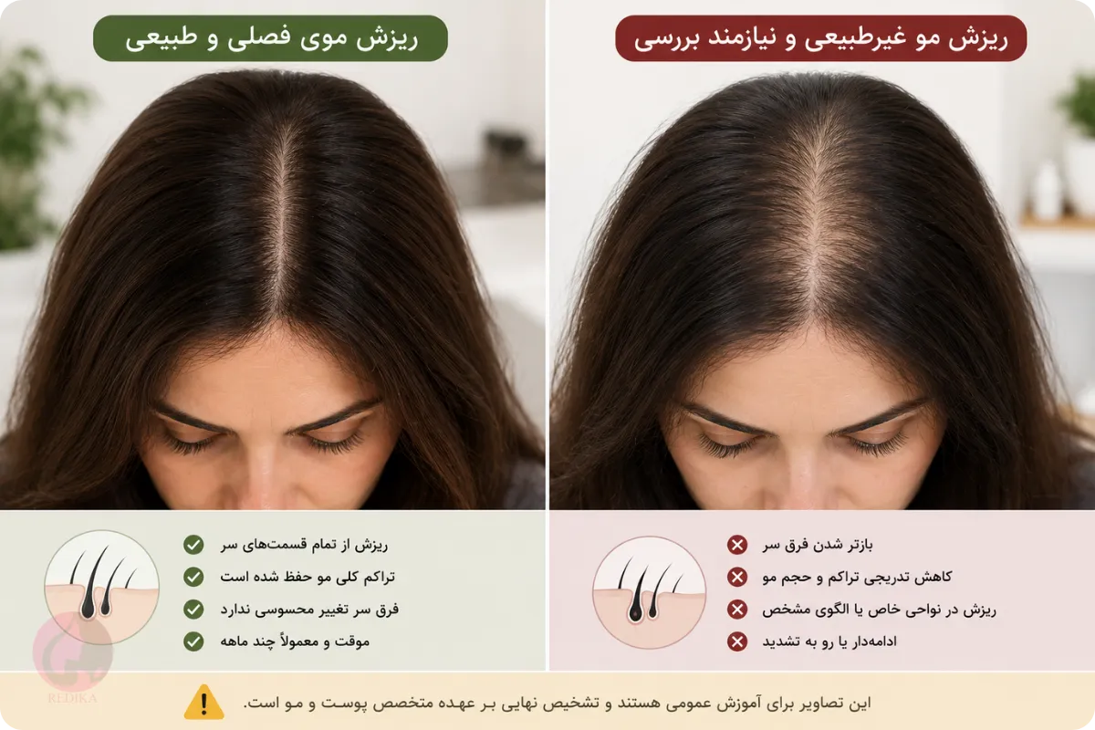 مقایسه ریزش موی فصلی طبیعی با ریزش موی غیرطبیعی و کاهش تراکم مو